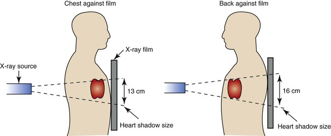 Diagram illustrating change in radiograph depending on patient positioning (facing away or toward x-ray tube)
