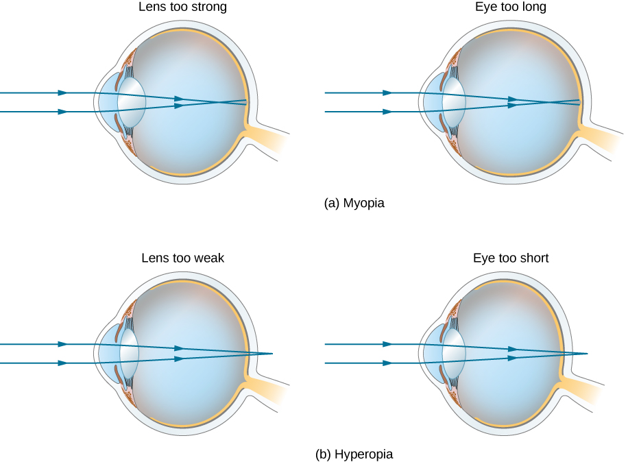 eye myoptia vs hyperopia 