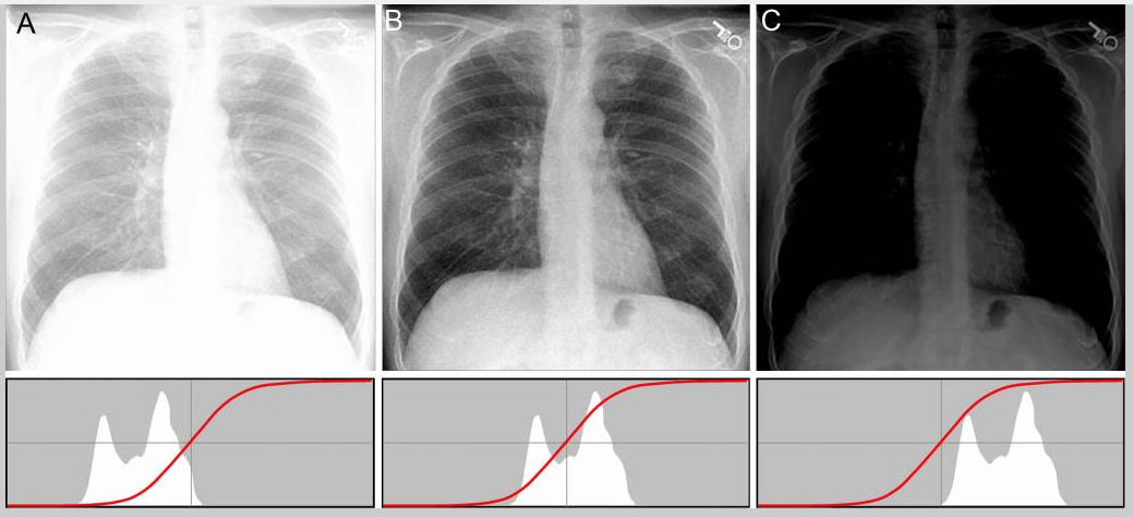 lung xray histograms