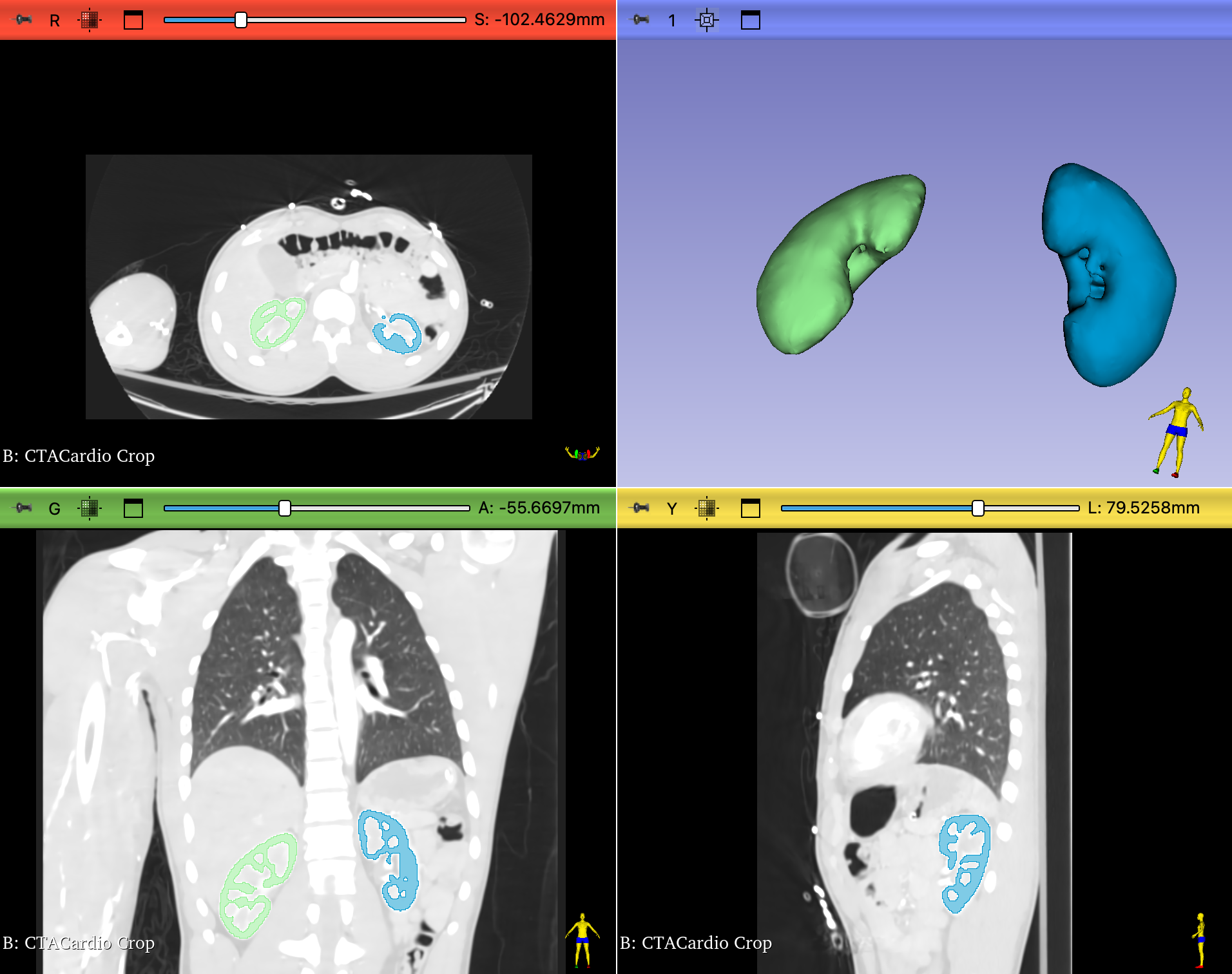 4up view of segmented kidneys