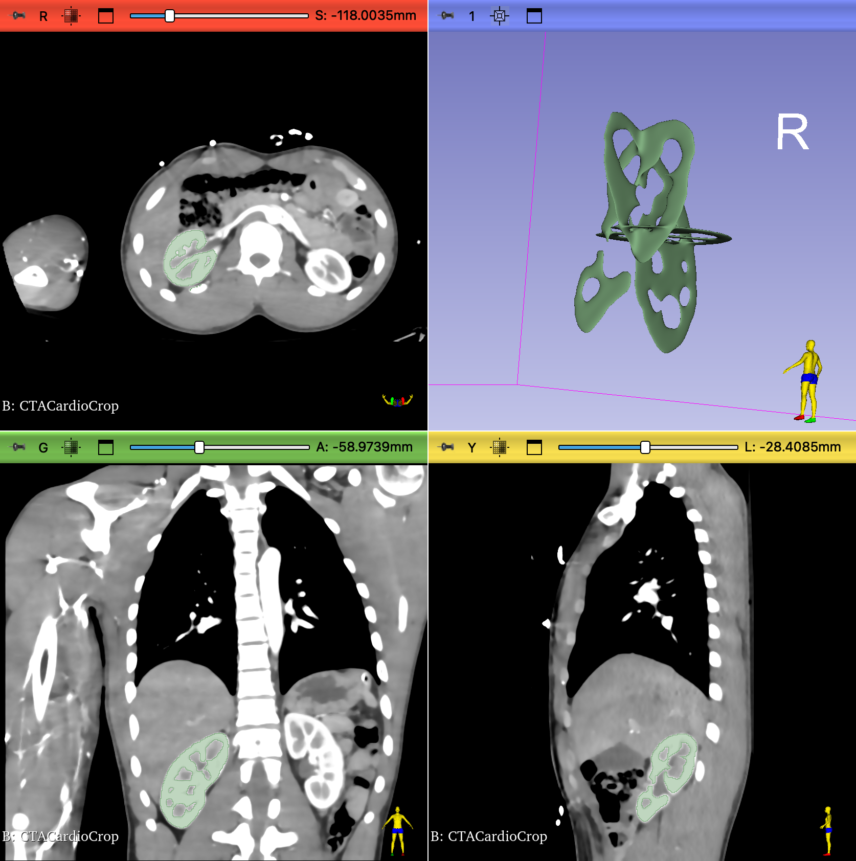 kidney segmentation