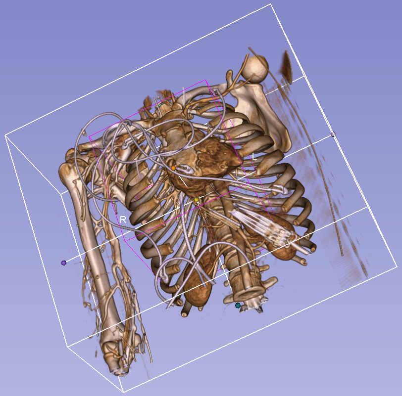 volume render CT Chest enhanced