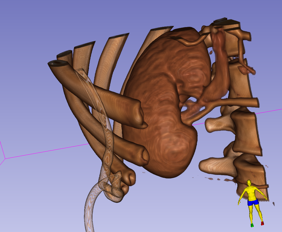 volume render kidney