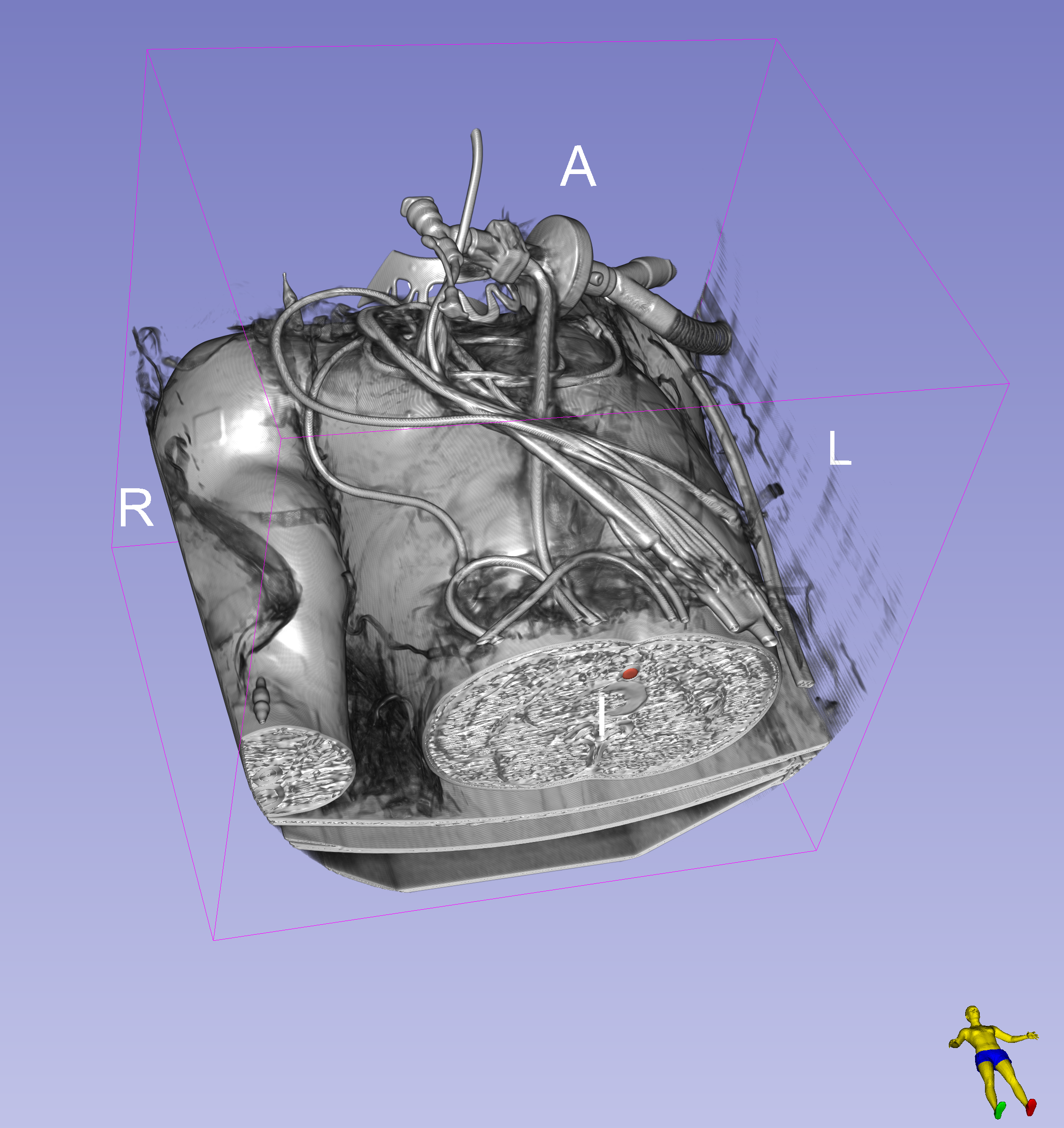 volume render CTA Cardio