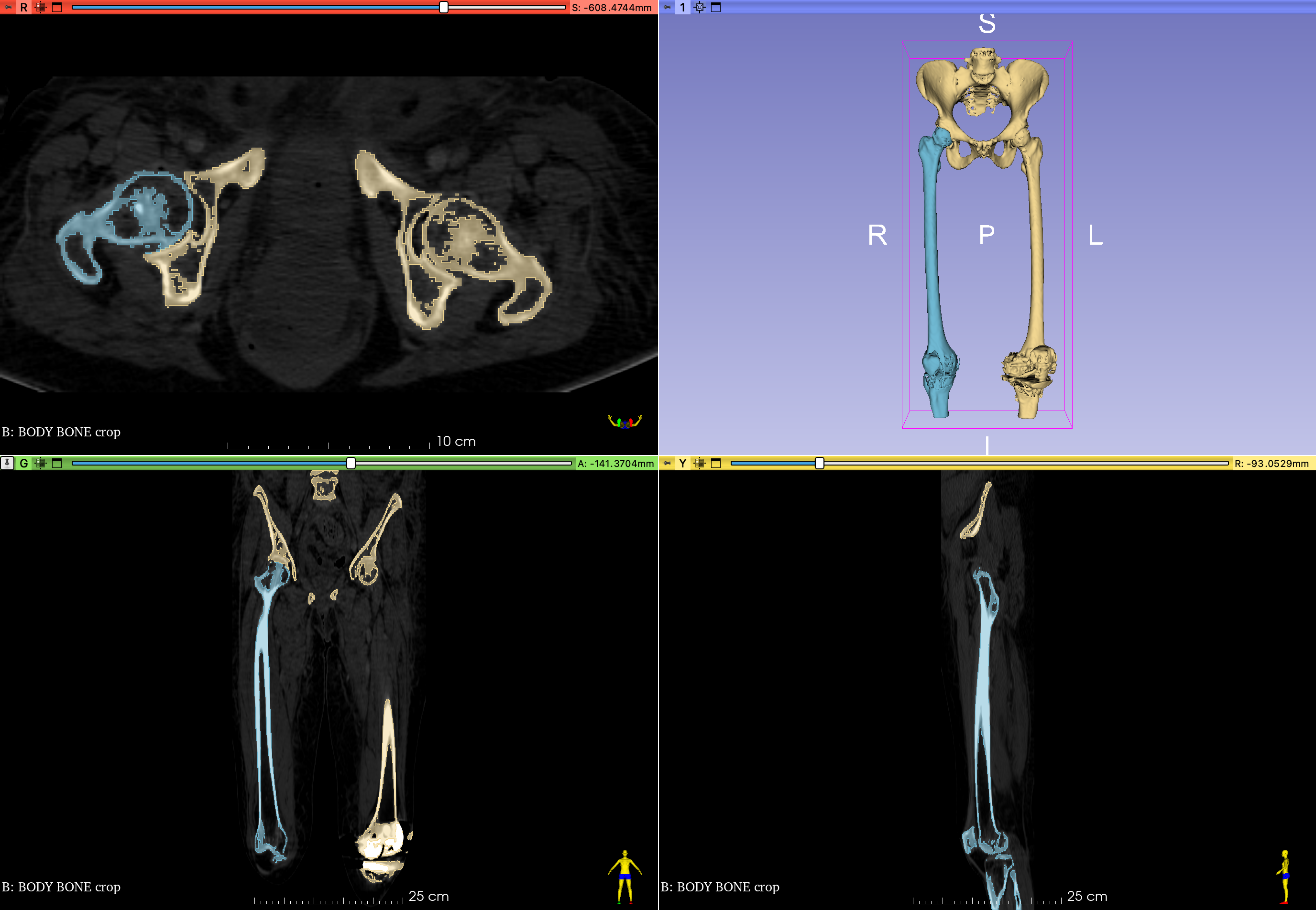 right femur 4up