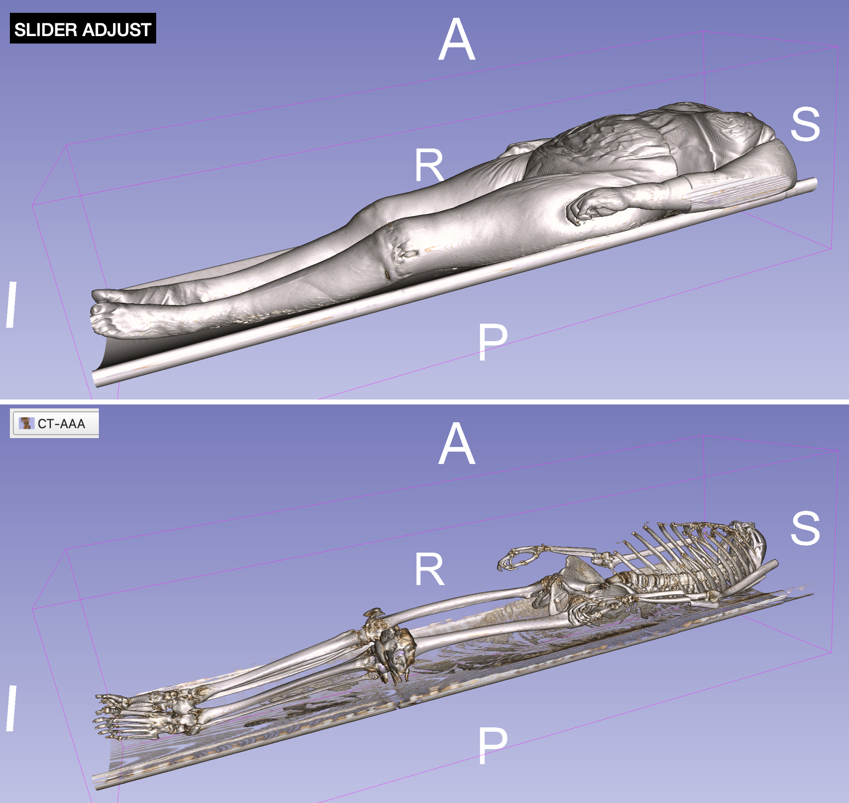 volume rendering of Body Bone