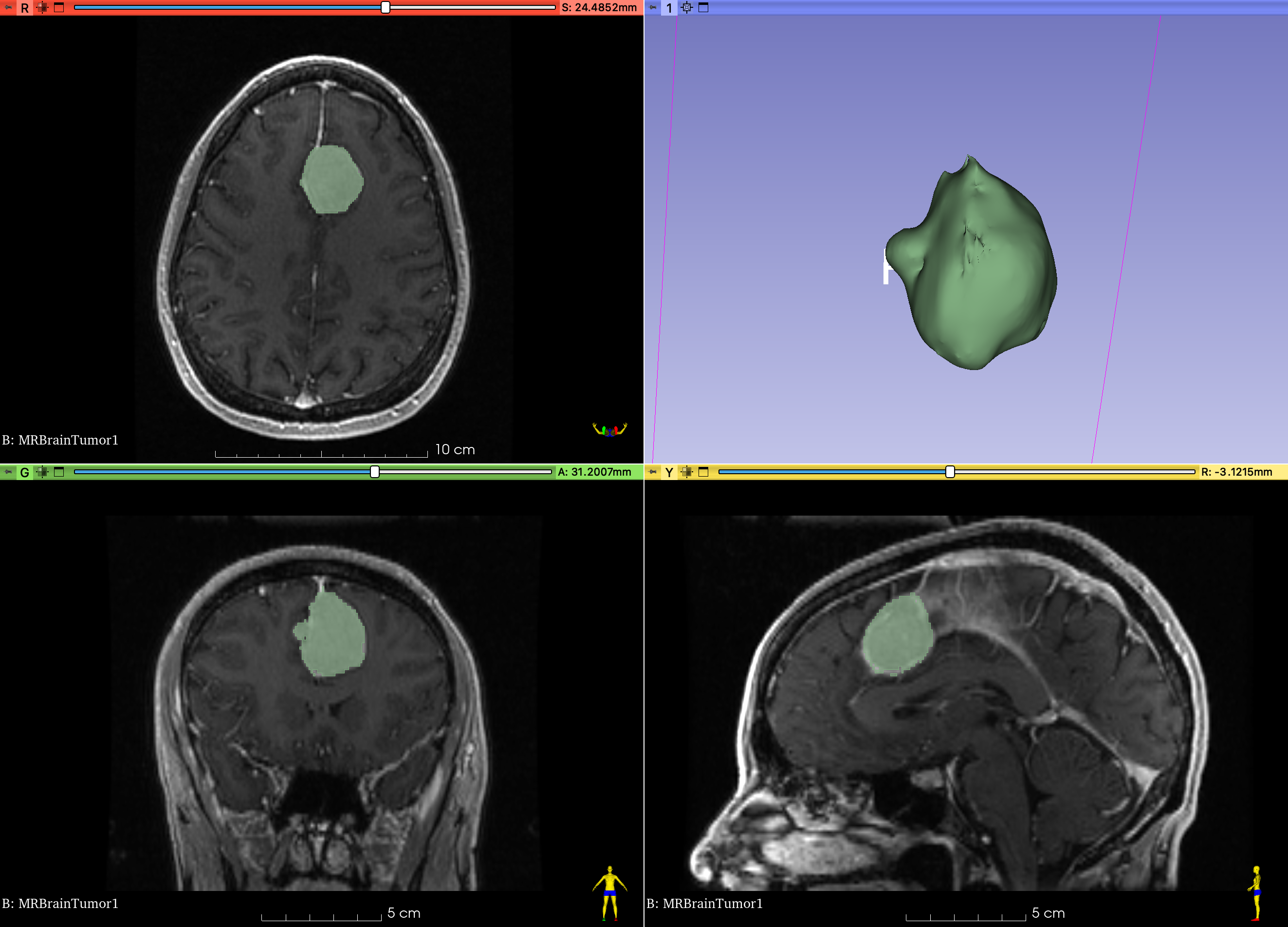 4up seg tumor1
