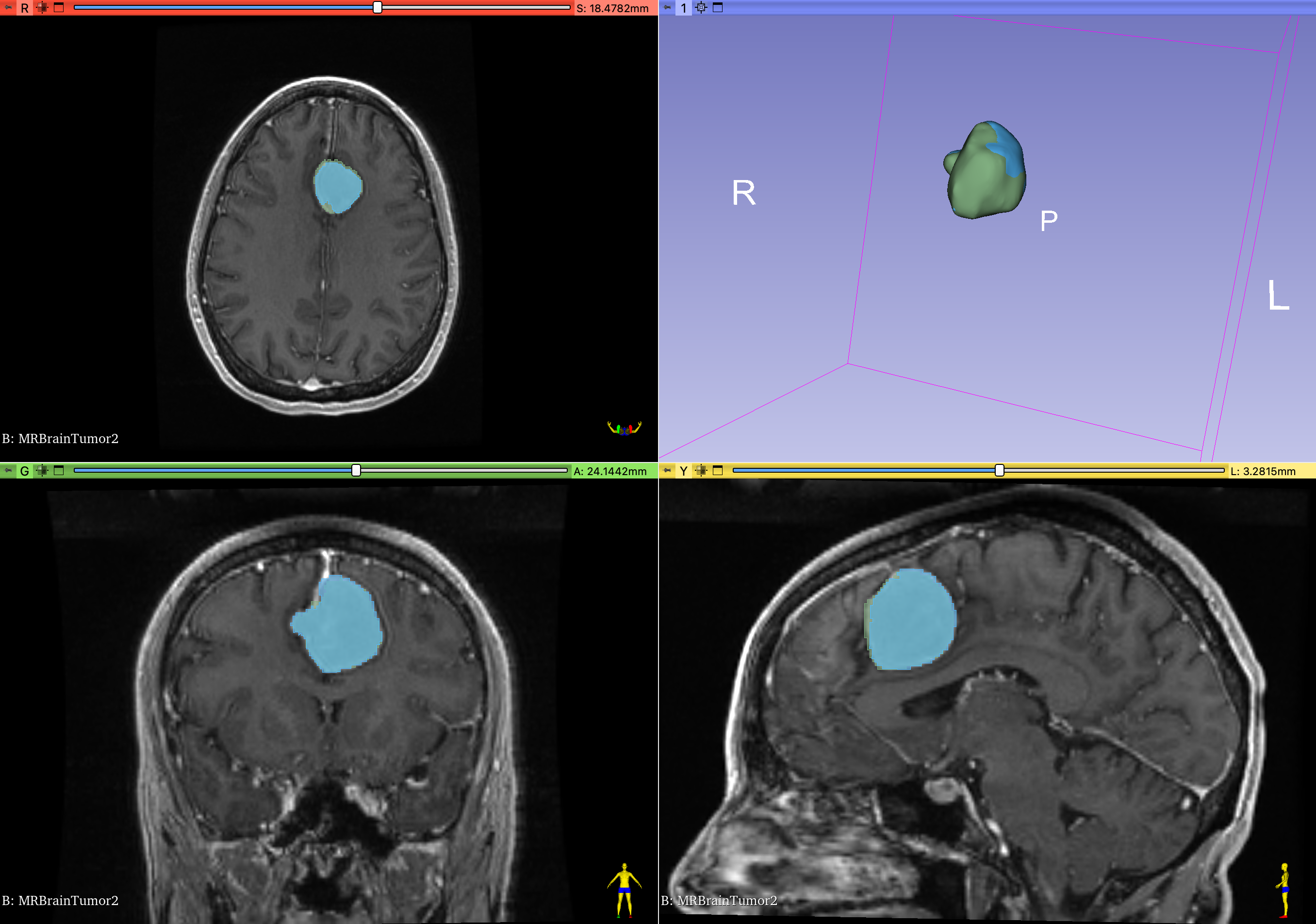 tumor overlay