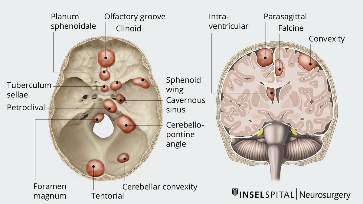 diagram meningiomas