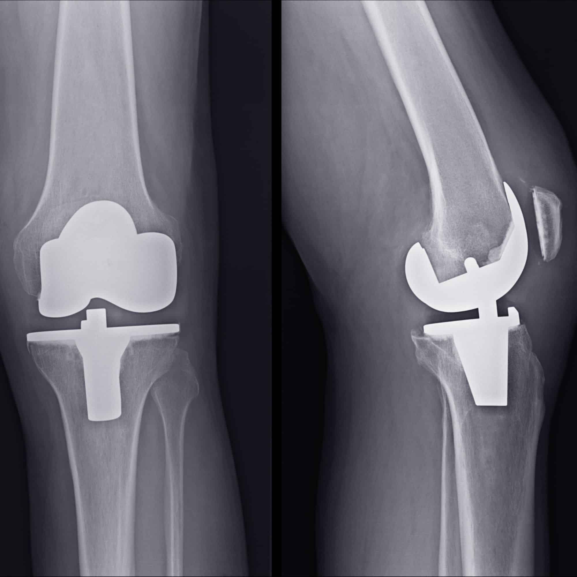total knee replacement x-ray